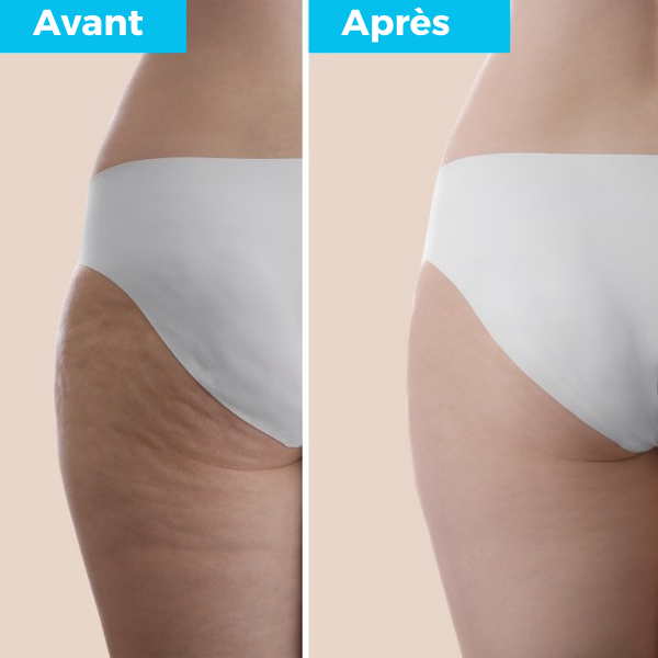 50% de réduction | Koliza Masseur infrarouge anti-cellulite 5 en 1